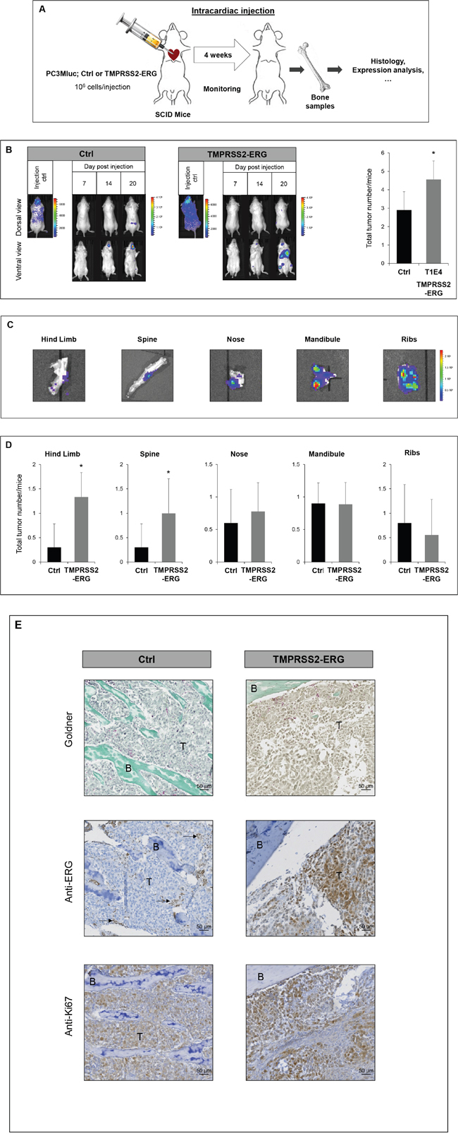 TMPRSS2-ERG fusion increases bone metastasis development.