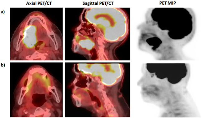 Pre- and post-therapy imaging for patient A.
