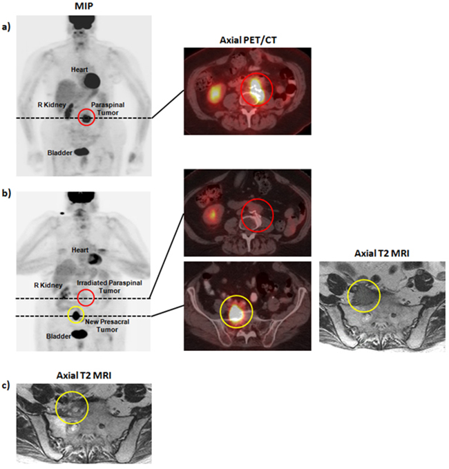 Pre- and post-therapy imaging for patient B.