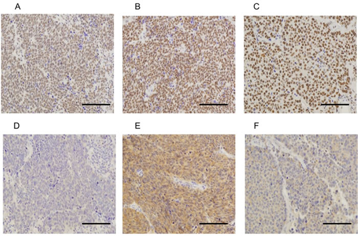 Representative examples of immunohistochemically stained sections positive for MED12 (A, B and C) and TGF-&#x3b2;RII (D, E and F) in tumor specimens.