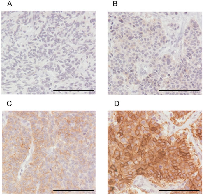 Representative examples of tumor specimens immunohistochemically stained for c-kit (&times;40 original magnification).