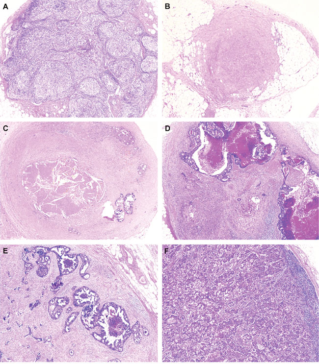 Representative images of lymph node regression grade (LRG) based on the percentage of residual tumor and fibrosis.