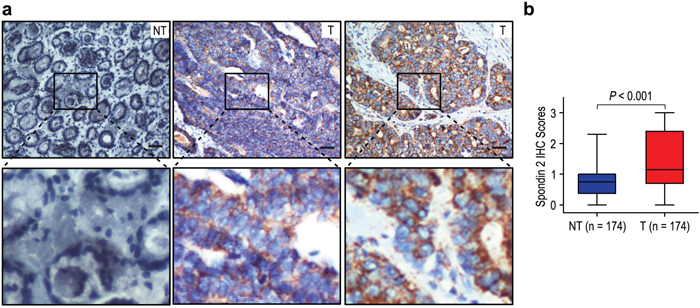 Spondin-2 was significantly up-regulated in gastric cancer.