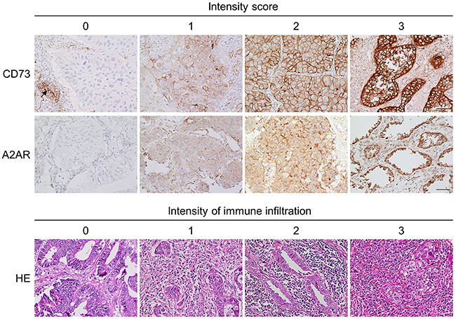 Representative images from an immunohistochemistry analysis of CD73 and A2AR and representative images for immune infiltration assessment.