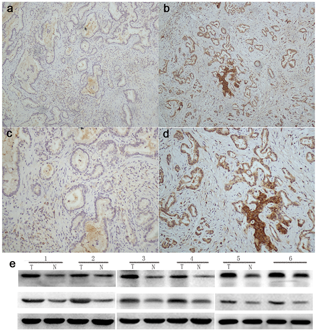 Integrin&#x03B2;6 expression in human gallbladder carcinoma.