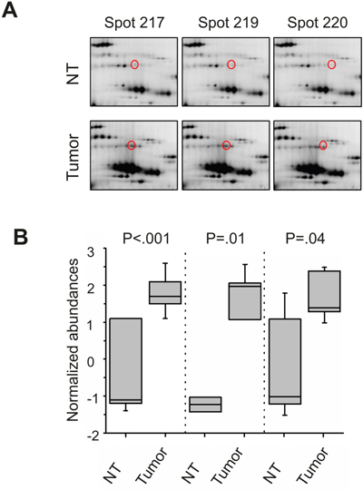 2D DIGE analysis with enriched phosphoproteins of HCC tissue lysates.