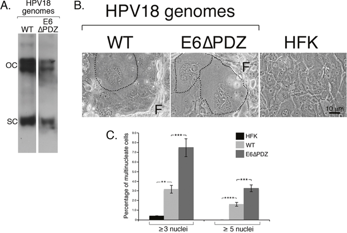Loss of E6 PBM function is associated with enhanced frequency of nuclear atypia of viral genome-containing cells.