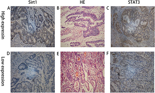 IHC staining showing high and low expression of SIRT1 and STAT3 in two patients with advanced gastric cancer and their matched HE staining slides.