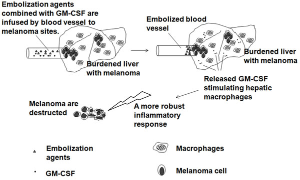 Immunoembolization with tumoricidal macrophage aggregation.