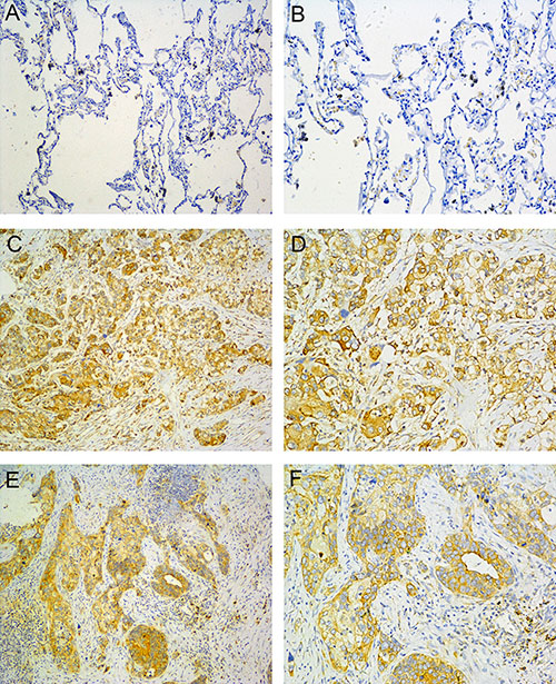 B7-H4 expression in NSCLC.