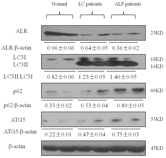 ALR expression is decreased in the liver of patients with LC and ALF.