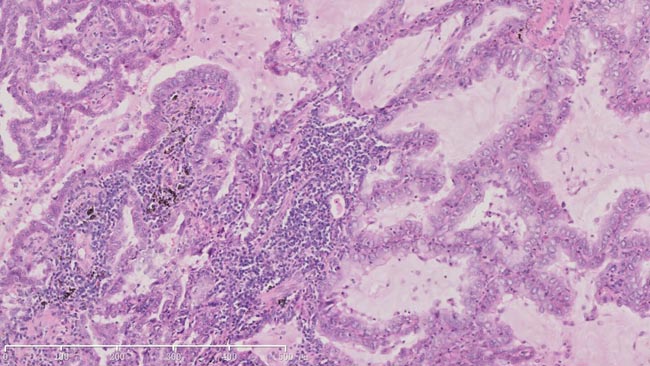 HE staining of surgical sample of lung showed histopathology of adenocarcinoma (X100).