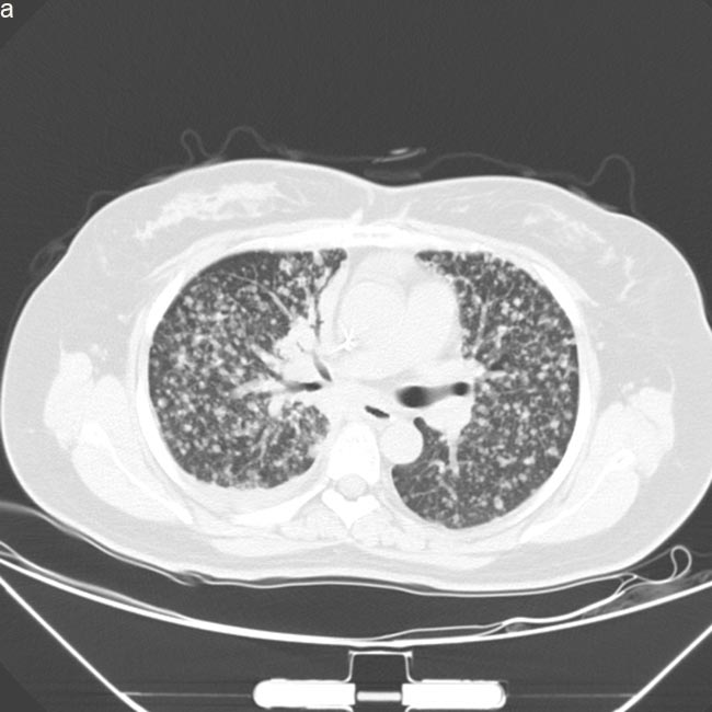 Computed tomography scan images of lung prior and post-AZD9291 treatment.