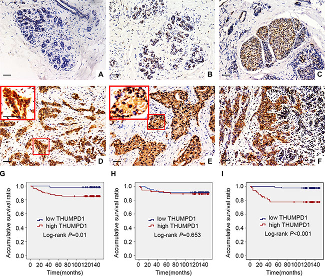 THUMPD1 expression and subcellular localization in breast tumors, and association with patient survival.