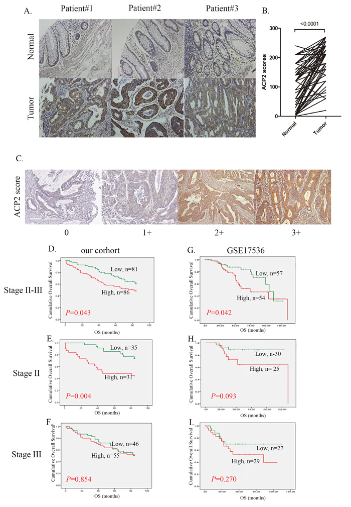 Correlation between ACP2 expression and prognosis in stage II and III CRC patients.