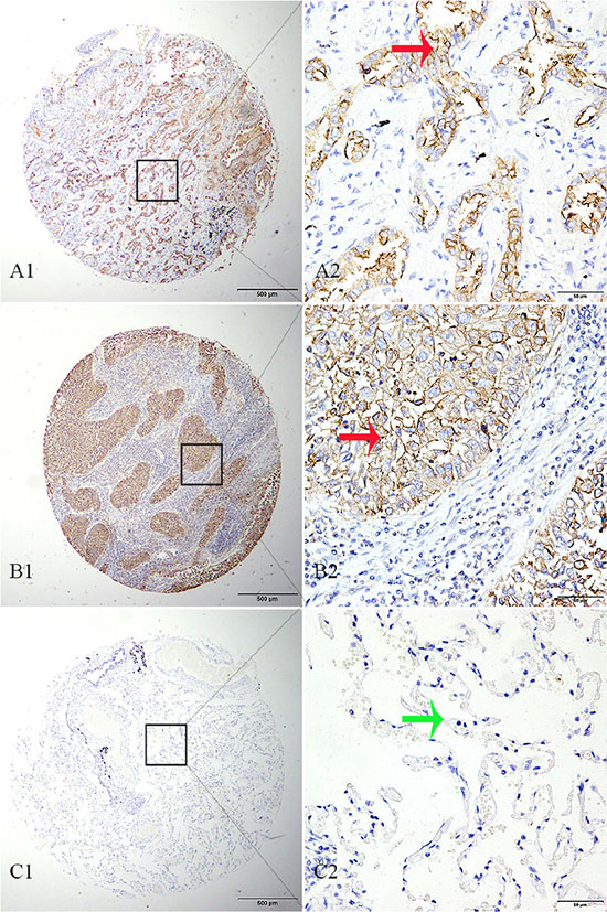 TMPRSS11D immunohistochemistry analysis in NSCLC and adjacent normal tissues.