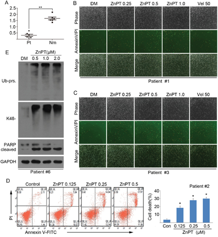 Effect of ZnPT on primary monocytes from leukemia patients.