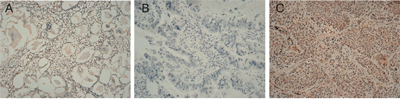 Immunohistochemical staining for FSIP1 in NSCLC tissues and non-tumor adjacent tissues. Magnification &#x00D7;200.