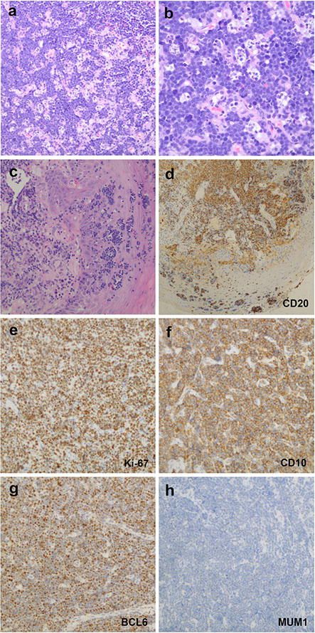 Histopathological and immunohistochemical characteristics of B-cell lymphomas involving WR.