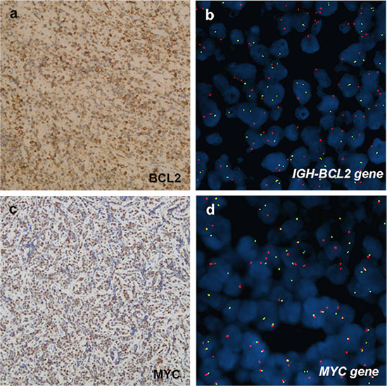 Immunohistochemical and cytogenetic features of B-cell lymphomas involving WR.