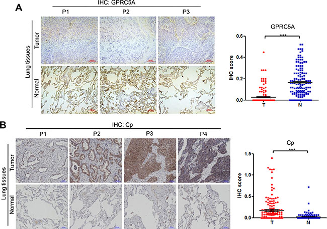 Protein levels of GPRC5A and ceruloplasmin in lung tissues of NSCLC.