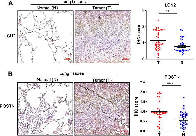 Protein levels of lipocalin2 and periostin in lung tissues of NSCLC.