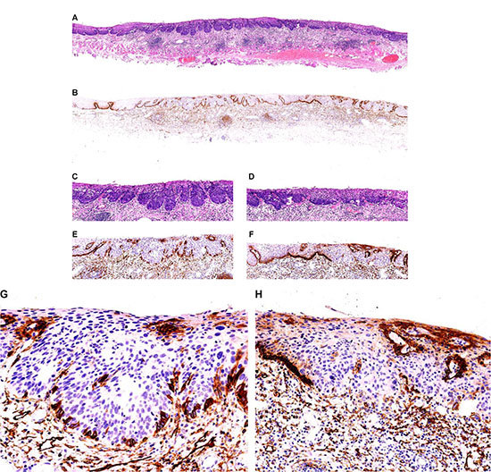 High-grade squamous intraepithelial lesions (HGEIN) and early infiltrative ESCC in esophageal mucosa.