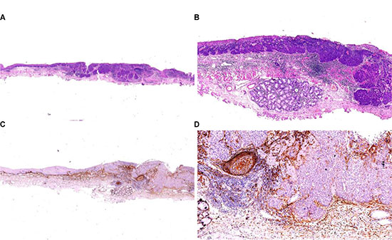 Infiltrative ESCC of the esophagus.