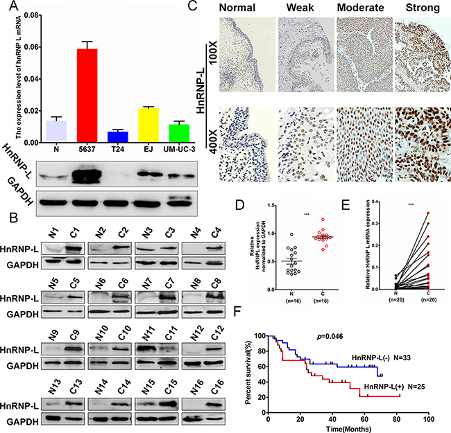 HnRNP-L expression in bladder cancer cell lines and the patients&#x2019; tissues.