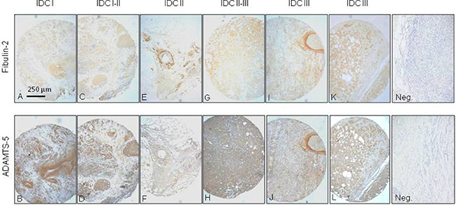 Immunohistochemical analysis of Fibulin-2 and ADAMTS-5 expression in breast cancer specimens.