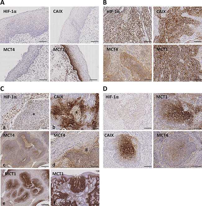Immunohistochemical staining for HIF-1&#x03B1;, CAIX, MCT4 and MCT1 in normal oropharyngeal normal mucosa and oropharyngeal SCCs.