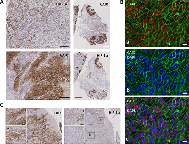 HIF-1&#x03B1; is consistently co-expressed with CAIX in tumor cells.