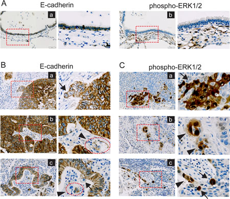Disseminating tumor cells at the marginal regions of tumors exhibit loss of E-cadherin and ERK activation.