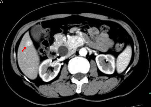 TACE in a 59-year-old female with multiple liver metastases form pancreatic neuroendocrine tumor.