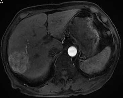 Eighty six-year-old male with a huge hypervascular metastatic pancreatic neuroendocrine tumor treated with multiple cycles of chemotherapy.