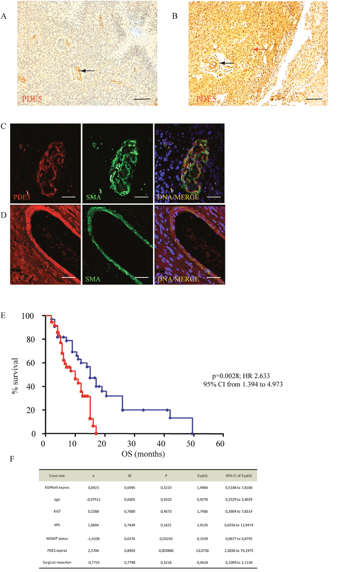 PDE5 expression correlates with OS in GBM.