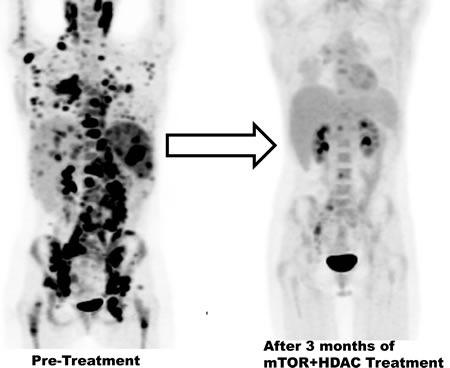 FDG PET/ CT scans showing metabolic response to therapy.
