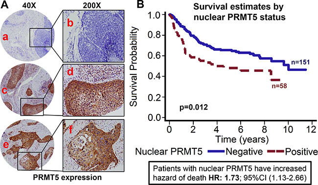Nuclear PRMT5 expression is associated with poor overall survival in OPSCC.