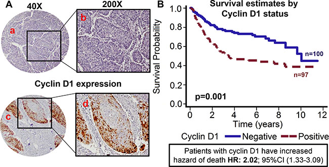 Cyclin D1 expression is associated with poor overall survival.