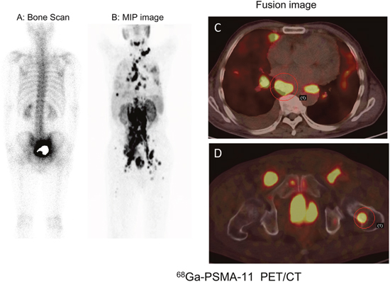 68Ga-PSMA-11 PET/CT versus bone scan for the evaluation of multiple metastases in a 73-year-old patient with right leg edema.