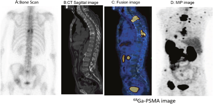 Thoracic spinal cord invasion was detected on 68Ga-PSMA-11 PET/CT images in a patient with mCRPC.