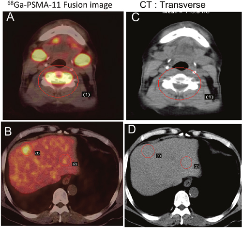 Early detection of PCa metastasis on 68Ga-PSMA-11 PET/CT images.