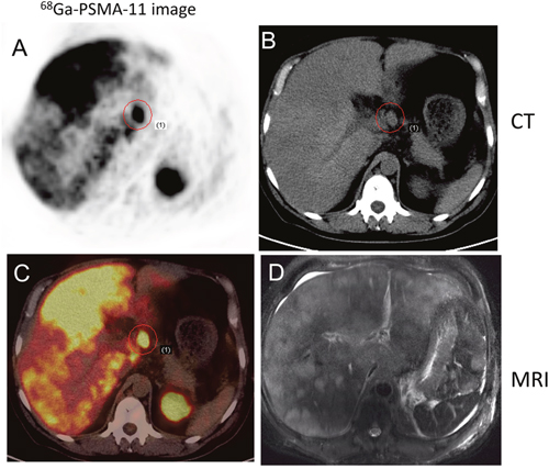68Ga-PSMA-11 PET/CT versus T2WI MRI in a 52-year-old patient with progressive disease.