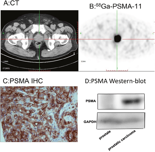 68Ga-PSMA-11 PET/CT enables quantitation of PSMA expression in the primary lesion, which was consistent with histopathological analysis.