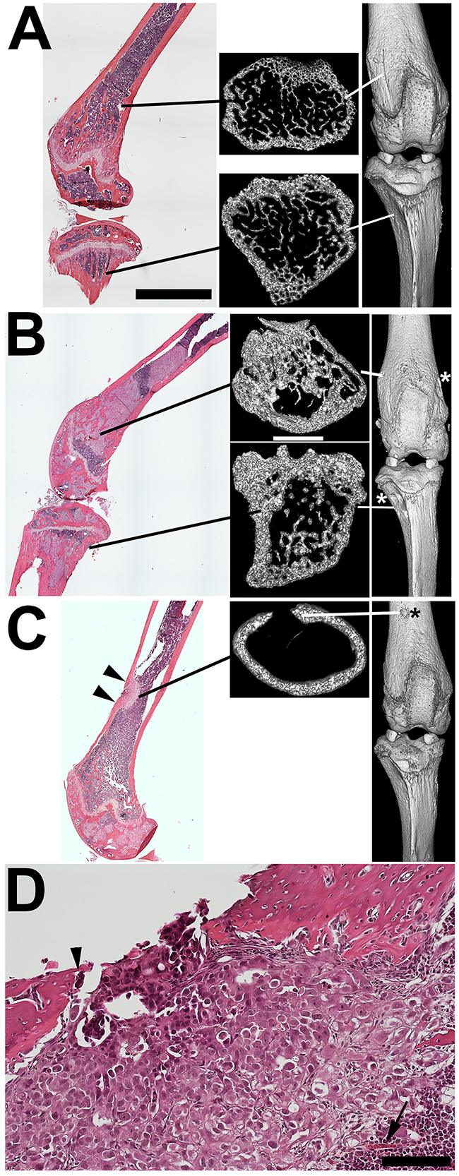 MicroCT reveals both bone remodeling consistent with metastatic tumor-mediated new bone formation and focal osteolysis.