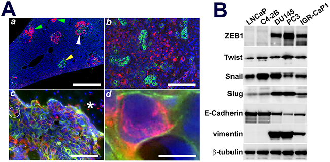 IGR-CaP1 metastatic subpopulations express organ dependent mixtures of epithelial or mesenchymal cell clusters or EMT in-transit cells.