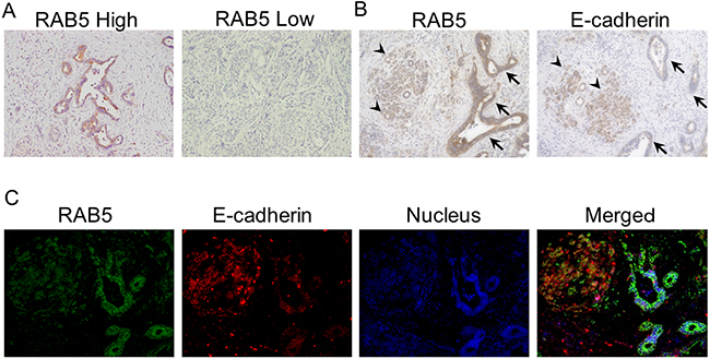 Immunohistochemical staining of RAB5 and E-cadherin in primary pancreatic cancer samples.