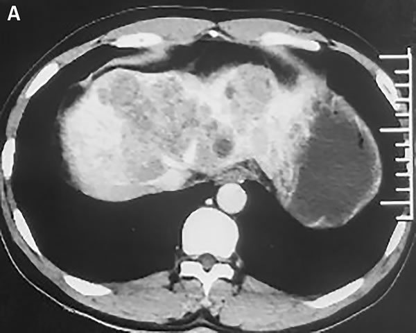 Abdomen CT images show that one of the lesions is located in the top of liver.