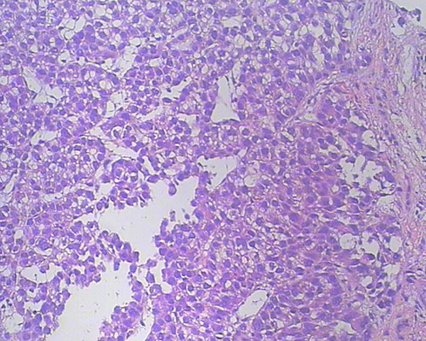 Hematoxylin and eosin staining of a tumor section (&times;200).