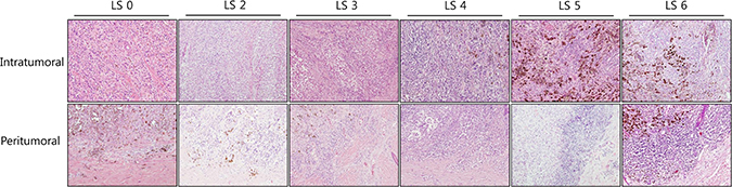 Microscopic examples of low and high lymphocyte scores in the intratumoral and peritumoral compartments of cutaneous melanomas.